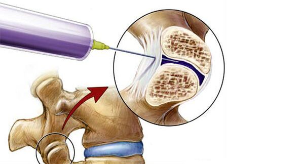 Bloqueo paravertebral para dor de costas